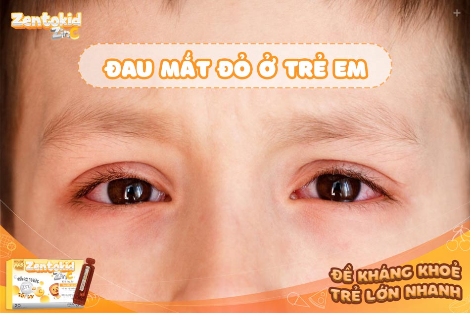 Đau mắt đỏ ở trẻ em: Nguyên nhân, triệu chứng, cách phòng ngừa